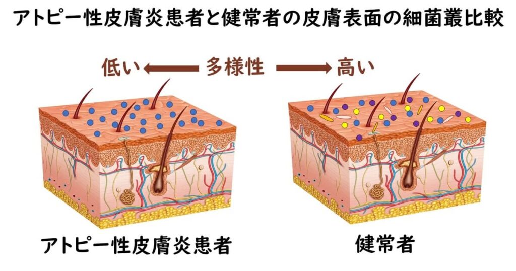 アトピー性皮膚炎患者と健常者の皮膚表面の細菌叢の比較