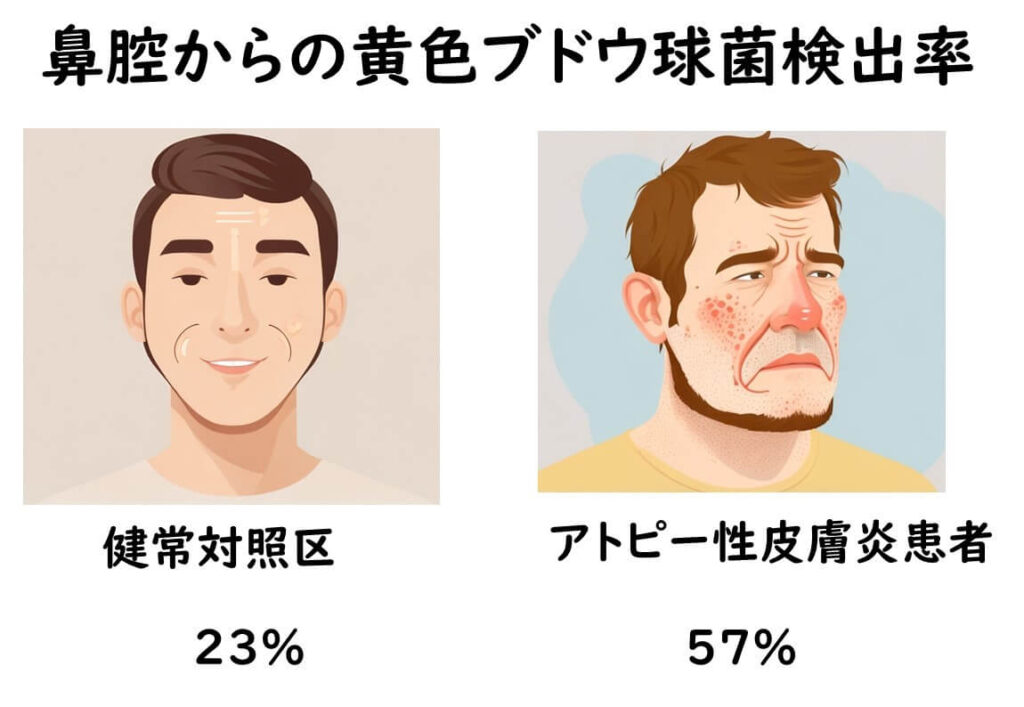 鼻腔からの黄色ブドウ球菌検出率の検出率の健常者とアトピー性皮膚炎患者の比較。