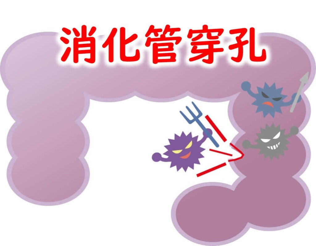 消化管穿孔